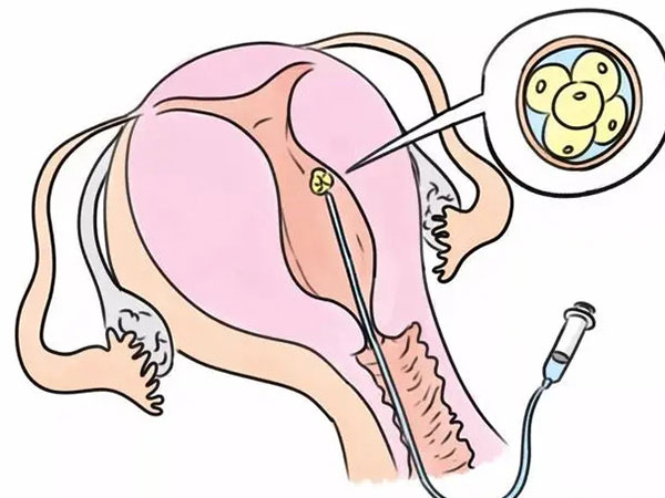 中山供卵试管助孕包成功：试管婴儿妇女的取卵过程用图来说明，整个过程只涉及5个步骤