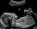 南京59岁助孕：新生儿拒食的5个最重要原因